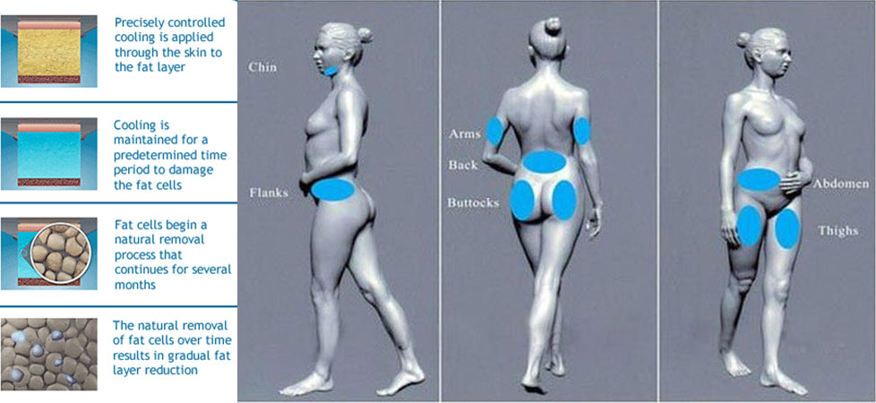 Cryolipolysis treatment areas
