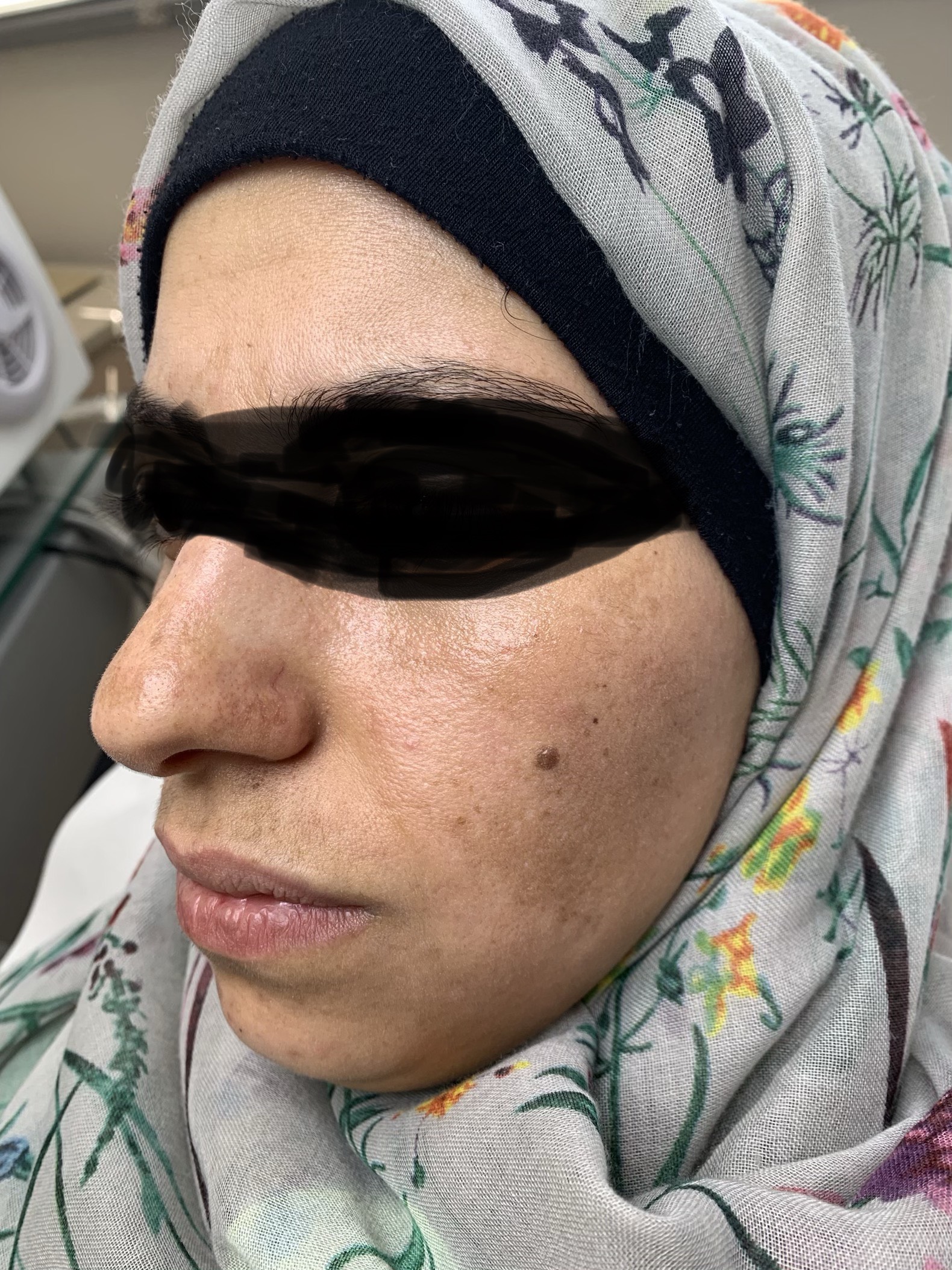 Fractional laser acne and scars result 6