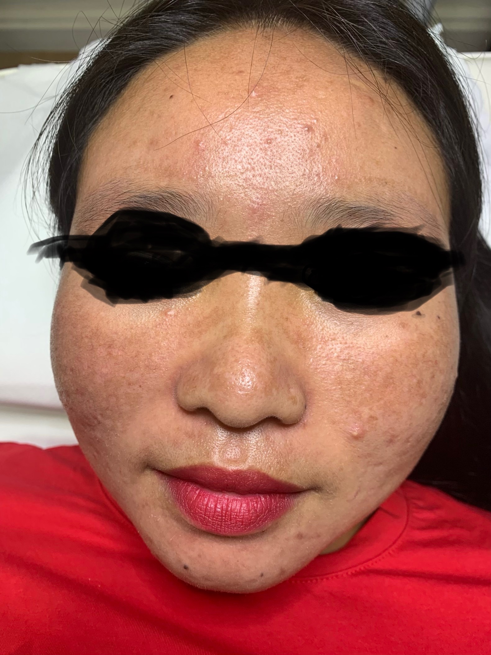 Fractional laser acne and scars result 9