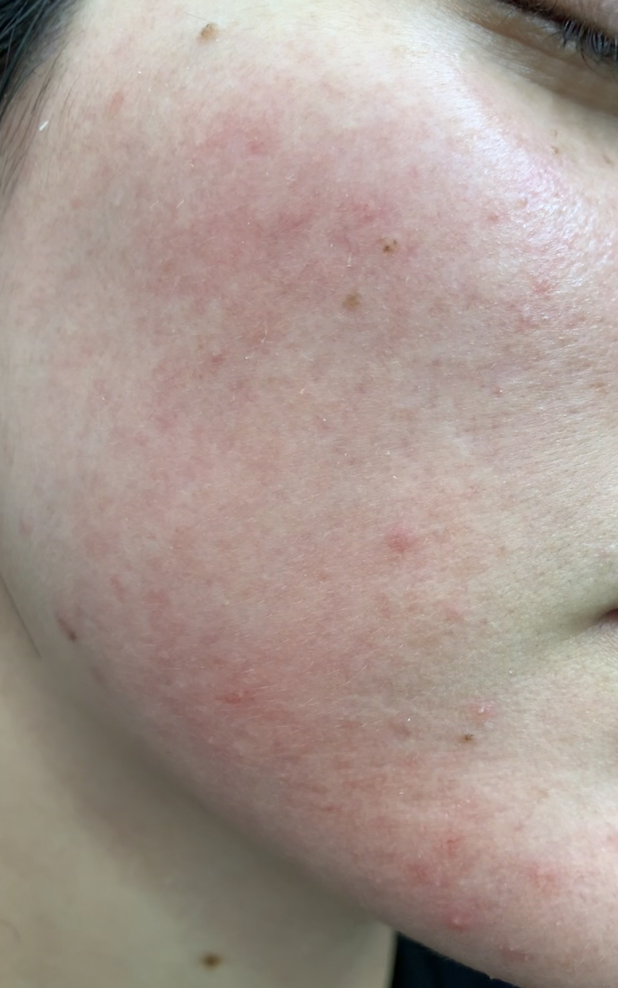 Fractional laser face result 4