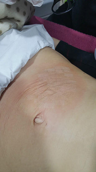 Fractional laser advanced stretch marks result 2