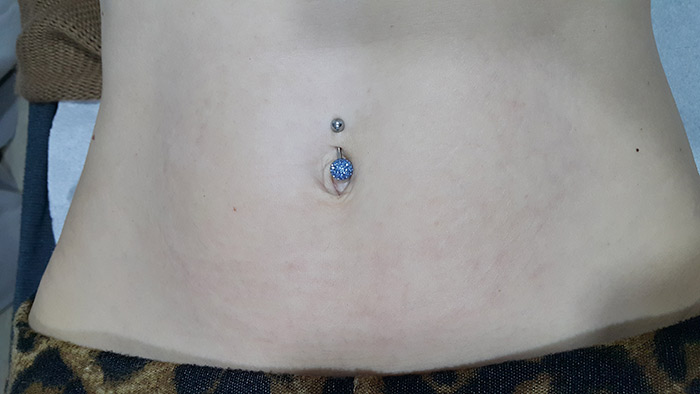 Fractional laser advanced stretch marks result 4