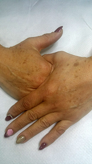 Fractional laser advanced stretch marks result 6