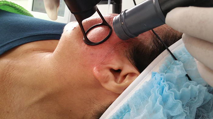 Fractional laser additional treatment result 5