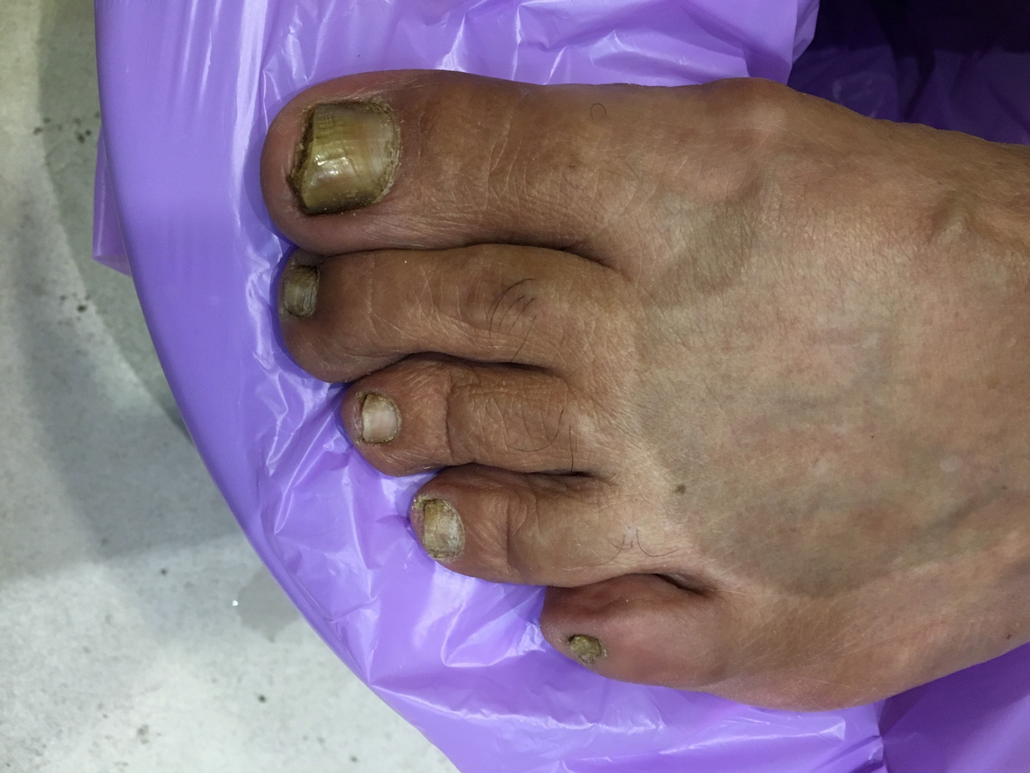 Laser nails fungus result 5