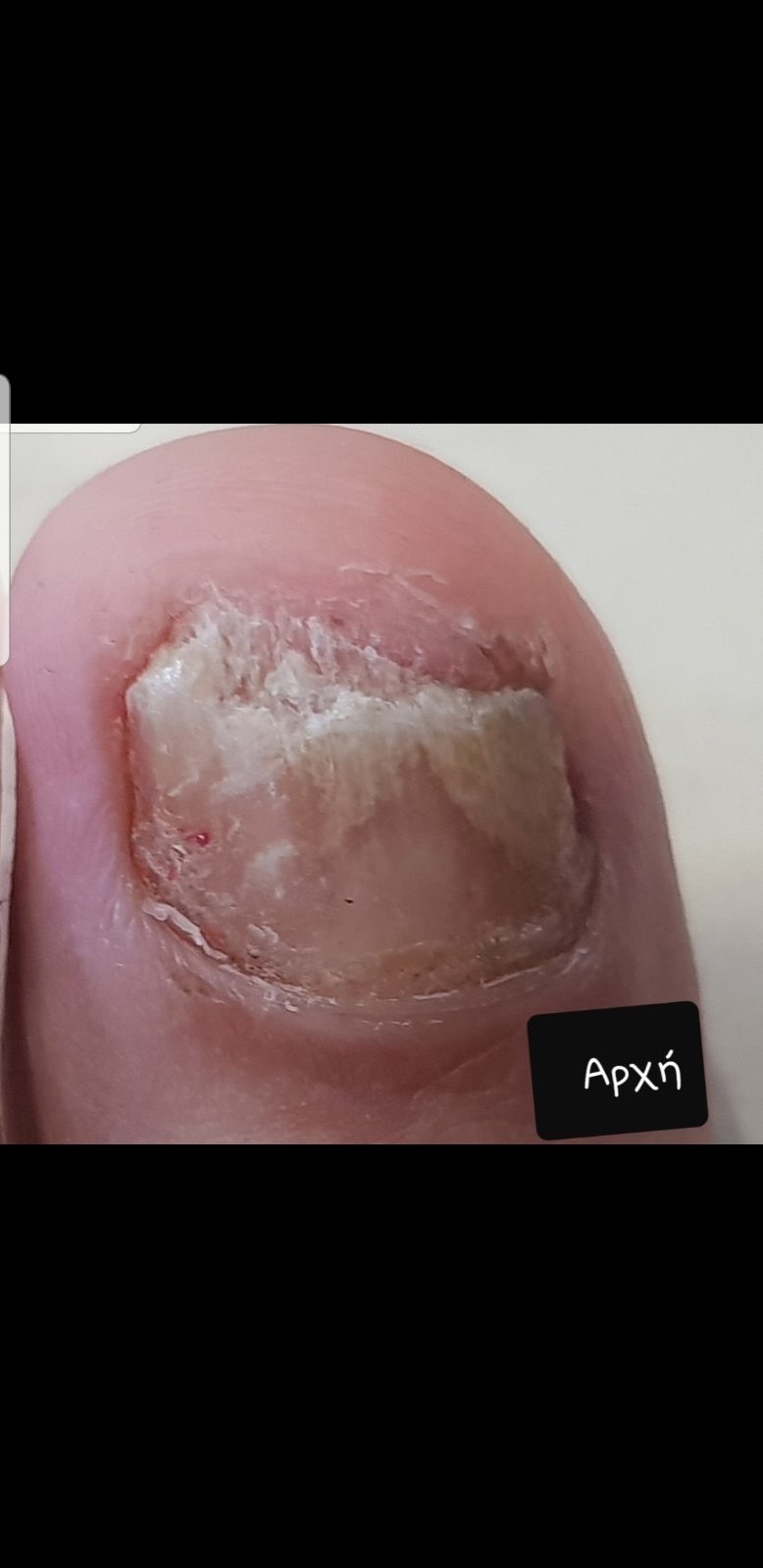 Laser nails fungus result 11