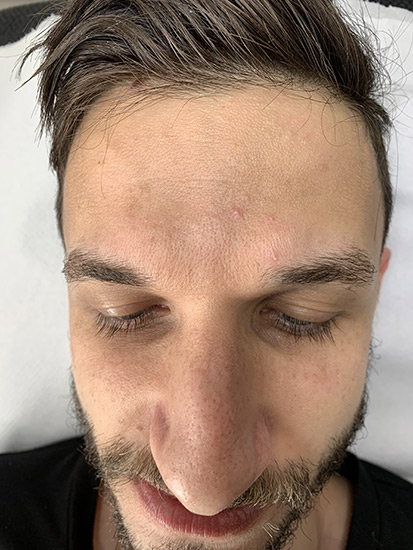 Carbon laser whitening result 2