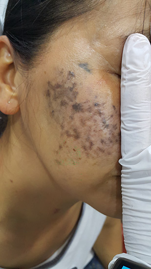 Carbon laser whitening result 4