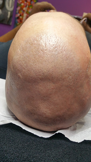 Laser tattoo removal before and after result 5