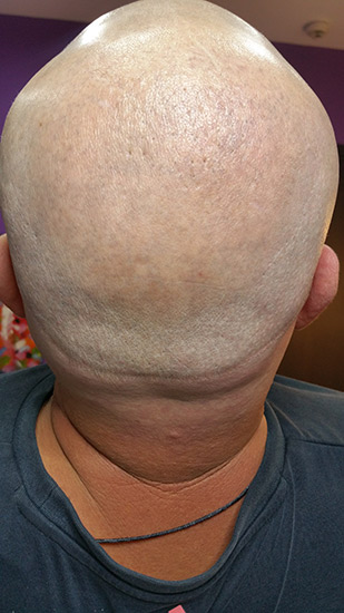 Laser tattoo removal before and after result 6
