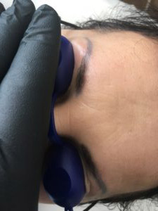 Laser tattoo removal before and after result 7